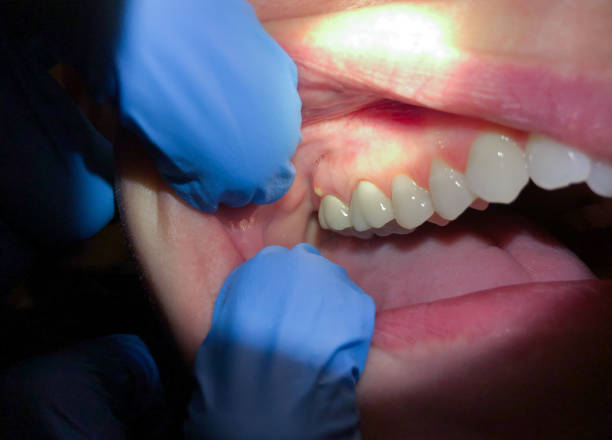 Best Cracked Tooth Emergency Dentist  in Eaton, OH